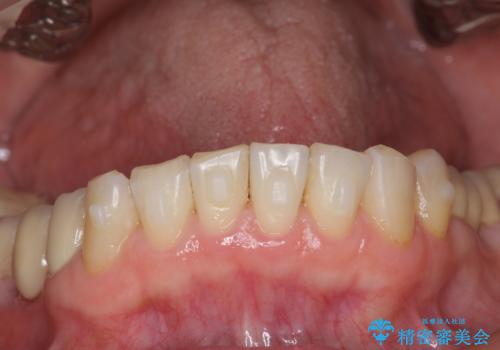 前歯の突き上げを改善する インビザライン による小矯正の治療中