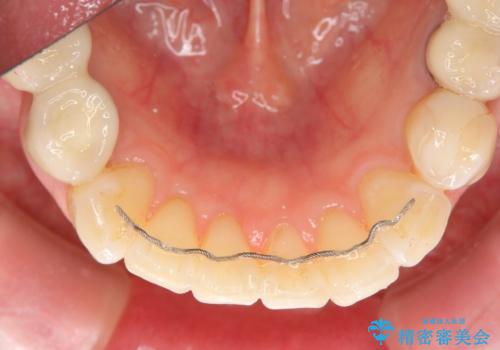前歯の突き上げを改善する インビザライン による小矯正の治療後