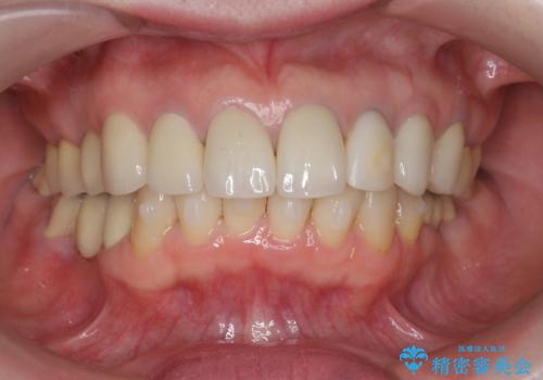 前歯の突き上げを改善する　インビザライン による小矯正の治療中