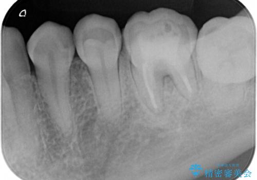 海外転勤前にセラミック治療の治療前