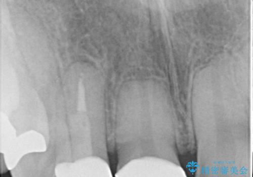 前歯のつめものが汚い セラミックできれいにの治療後