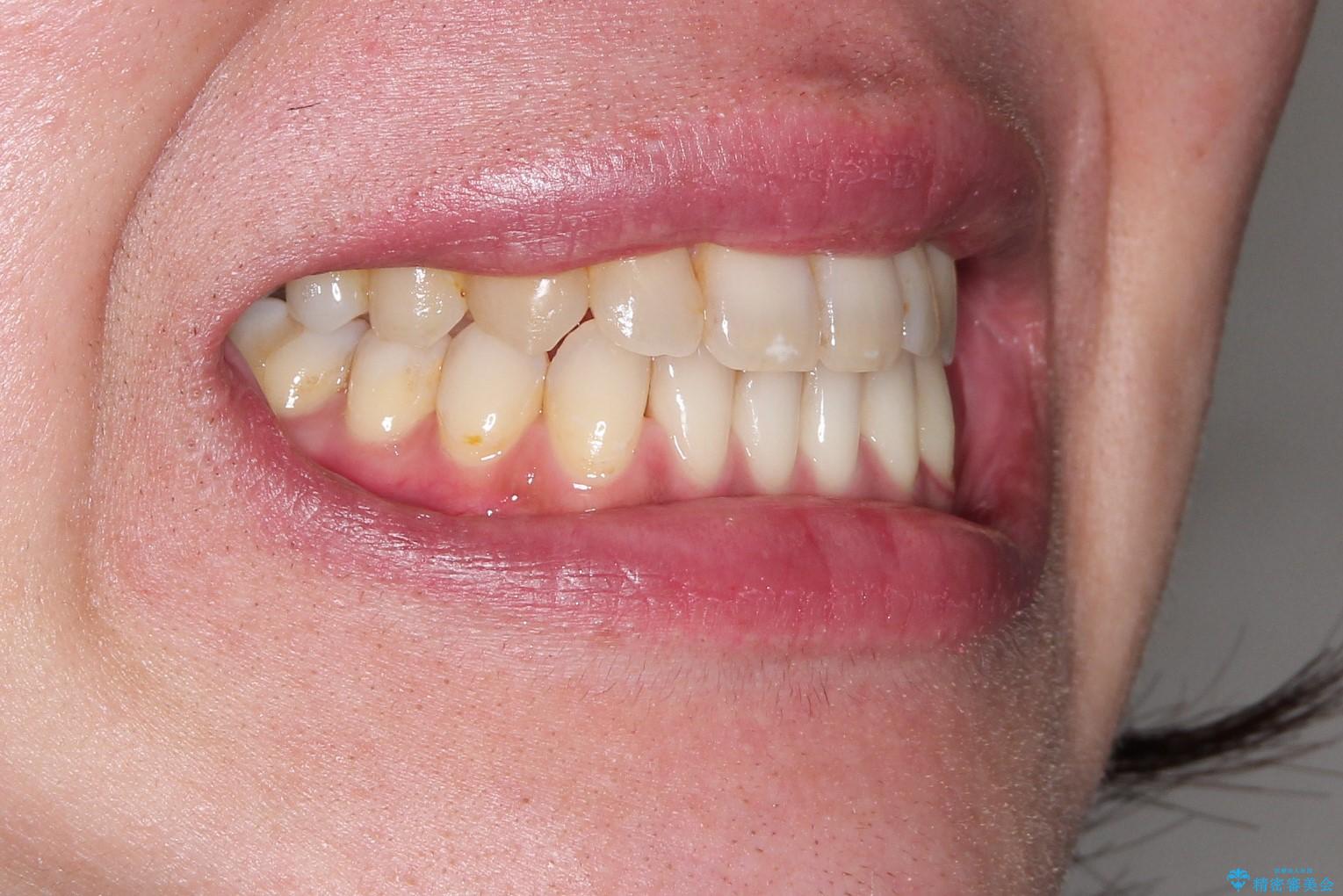 Invisalign インビザライン によるガタつき、受け口傾向の改善の治療後(顔貌)