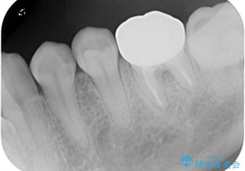 海外転勤前にセラミック治療の治療後