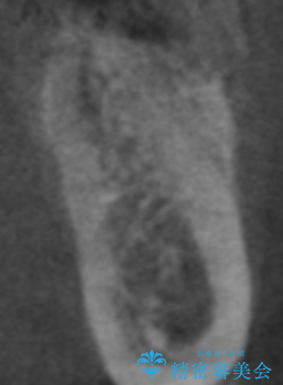 骨が薄い部位への骨造成をともなうインプラントの治療後