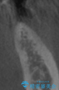 骨が薄い部位への骨造成をともなうインプラントの治療前