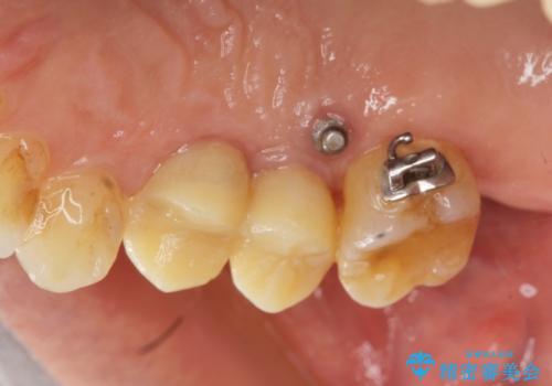 部分矯正を含む 歯周病治療 (再生治療・歯周ポケット除去・MTM・連結補綴)の治療中