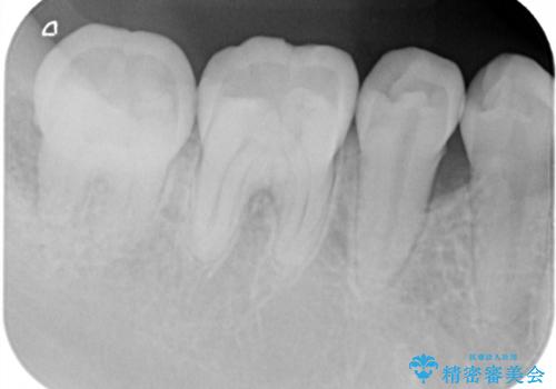 このままでは抜歯と言われた 失われた骨の再生治療 の治療前