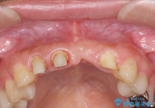 不良インプラントの除去・骨造成・歯肉移植・前歯審美セラミックブリッジ製作の治療前