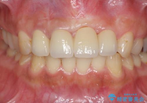 不良インプラントの除去・骨造成・歯肉移植・前歯審美セラミックブリッジ製作の治療後