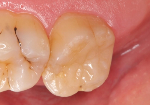 銀歯の劣化・セラミックインレー修復の症例 治療後