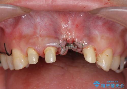 不良インプラントの除去・骨造成・歯肉移植・前歯審美セラミックブリッジ製作の治療中