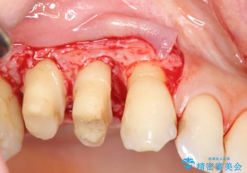 部分矯正を含む 歯周病治療 (再生治療・歯周ポケット除去・MTM・連結補綴)の治療前