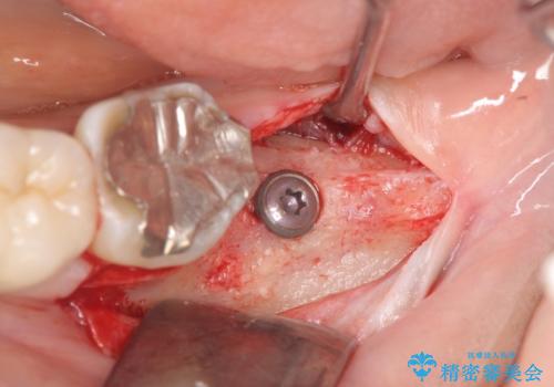 歯の破折による抜歯 インプラントによる咬合機能回復の治療中