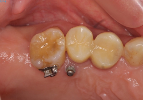 部分矯正を含む 歯周病治療 (再生治療・歯周ポケット除去・MTM・連結補綴)の治療前