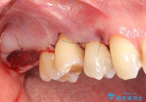 部分矯正を含む 歯周病治療 (再生治療・歯周ポケット除去・MTM・連結補綴)の治療後