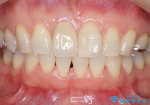 前歯の変色 セラミック審美補綴の治療後
