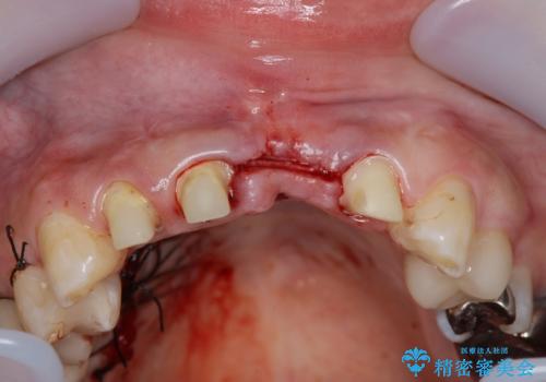 不良インプラントの除去・骨造成・歯肉移植・前歯審美セラミックブリッジ製作の治療前