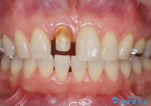 前歯の変色 セラミック審美補綴の治療中