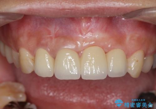 不良インプラントの除去・骨造成・歯肉移植・前歯審美セラミックブリッジ製作の治療後