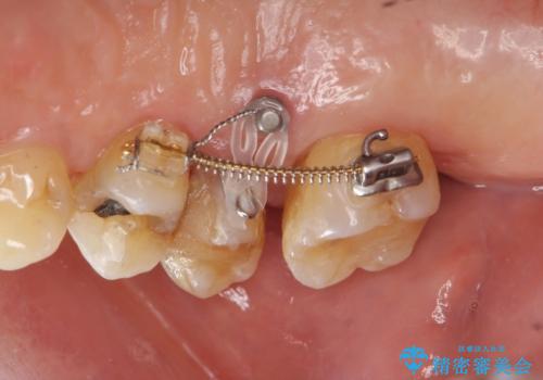 部分矯正を含む　歯周病治療 (再生治療・歯周ポケット除去・MTM・連結補綴)の治療中