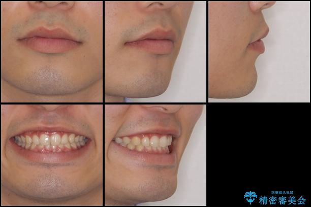 インビザラインによる、すきっ歯の改善の治療後（顔貌）