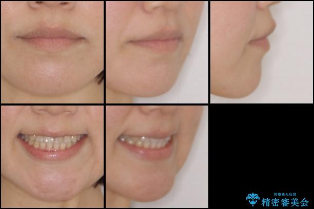 前歯の反対咬合　非抜歯のワイヤー矯正の治療後（顔貌）