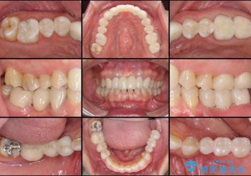 飛行機を利用しての通院 気になる所を全て治療する総合歯科治療の治療後