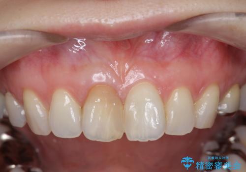前歯の変色 セラミック審美補綴の治療前