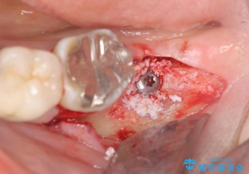 歯の破折による抜歯 インプラントによる咬合機能回復の治療後