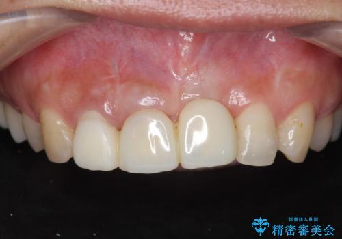 不良インプラントの除去・骨造成・歯肉移植・前歯審美セラミックブリッジ製作の症例 治療前