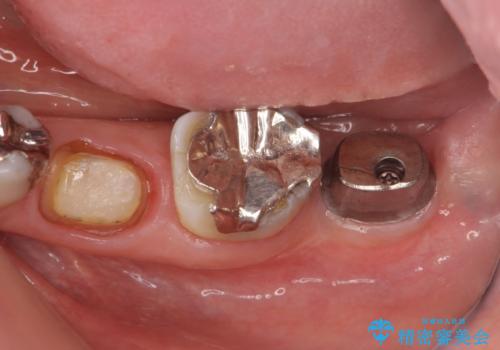歯の破折による抜歯 インプラントによる咬合機能回復の治療中