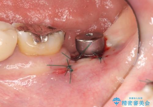歯の破折による抜歯 インプラントによる咬合機能回復の治療前