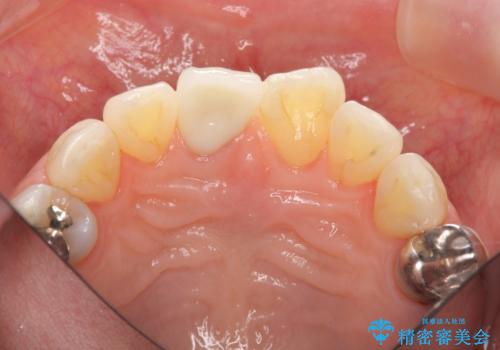 前歯の変色 セラミック審美補綴の治療後