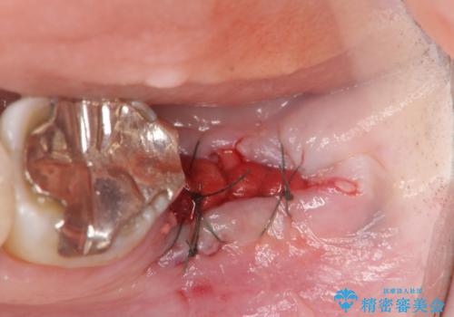 歯の破折による抜歯 インプラントによる咬合機能回復の治療中