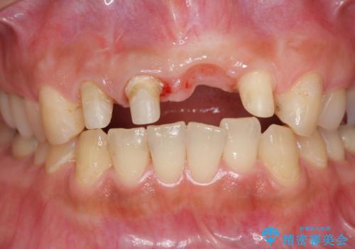 不良インプラントの除去・骨造成・歯肉移植・前歯審美セラミックブリッジ製作の治療中