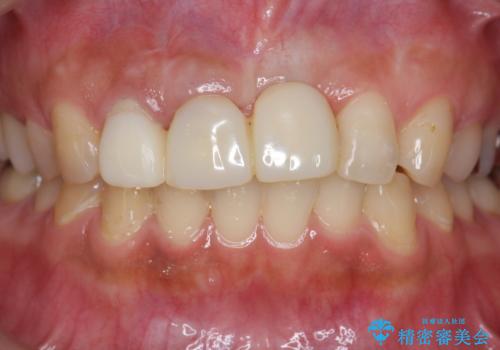不良インプラントの除去・骨造成・歯肉移植・前歯審美セラミックブリッジ製作の治療前