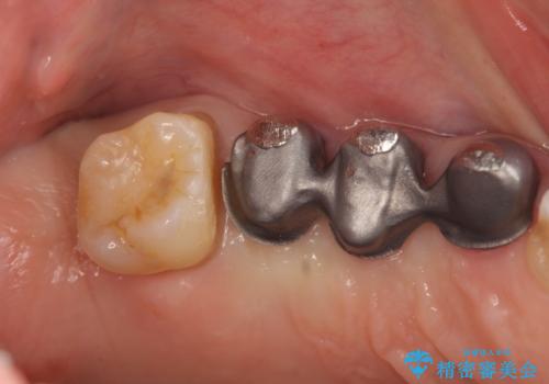 部分矯正を含む 歯周病治療 (再生治療・歯周ポケット除去・MTM・連結補綴)の治療中