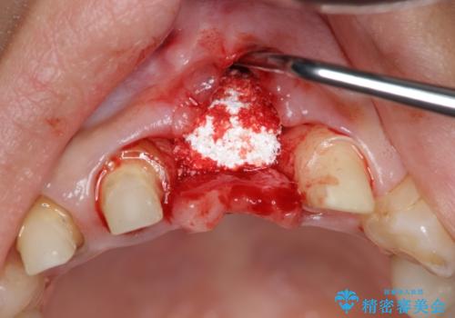 不良インプラントの除去・骨造成・歯肉移植・前歯審美セラミックブリッジ製作の治療前