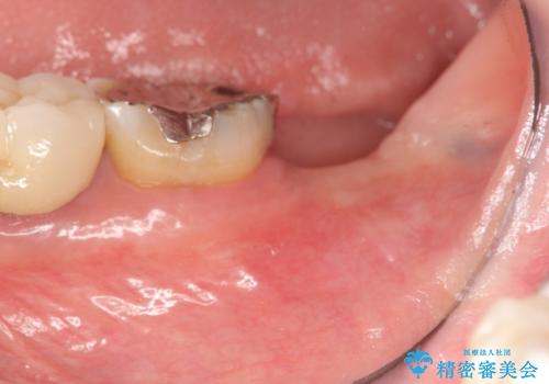 歯の破折による抜歯 インプラントによる咬合機能回復の治療前