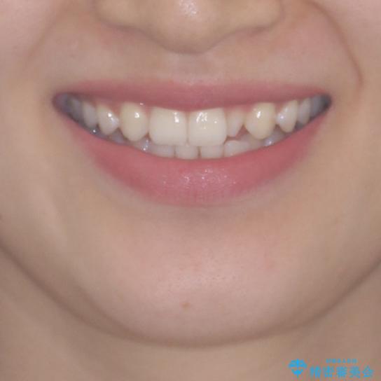 海外転居前に気になる前歯を整えたい　上下前歯の部分矯正の治療前（顔貌）