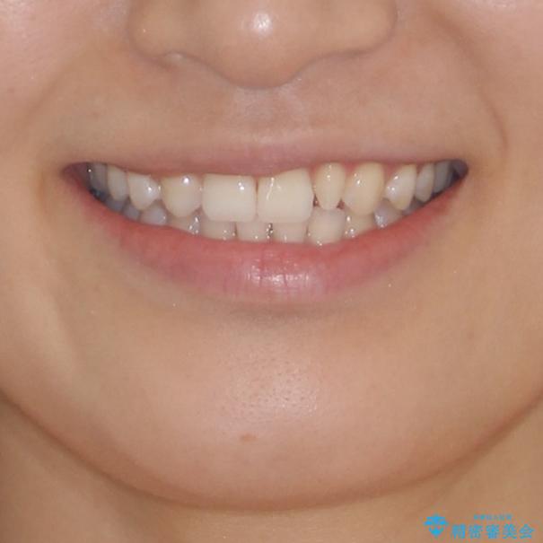 海外転居前に気になる前歯を整えたい　上下前歯の部分矯正の治療後（顔貌）