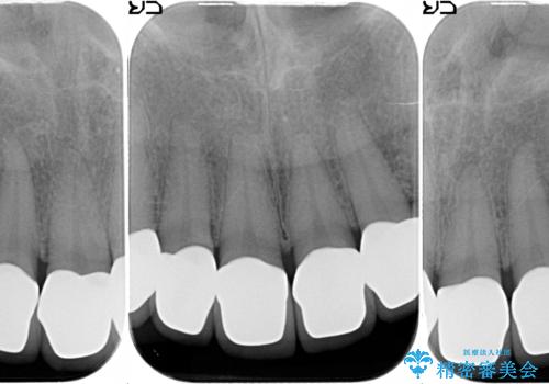 オールセラミッククラウン 前歯部の見た目の改善の治療後