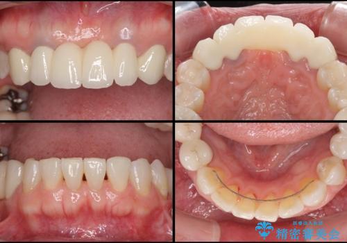飛行機を利用しての通院 気になる所を全て治療する総合歯科治療の治療後