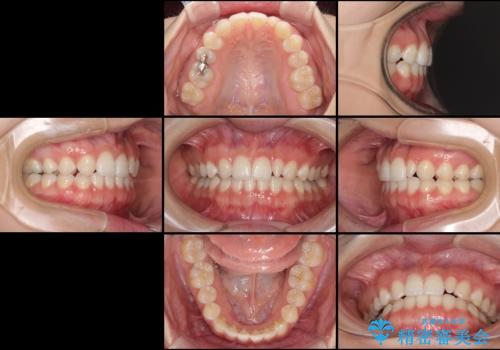 海外転居前に気になる前歯を整えたい 上下前歯の部分矯正の治療後