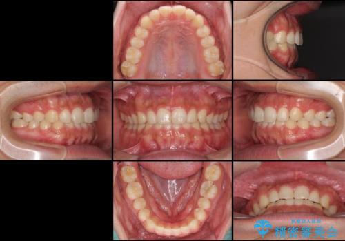 インビザラインによる、すきっ歯の改善の治療後