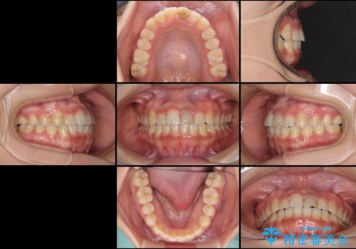 前歯の反対咬合 非抜歯のワイヤー矯正の治療後