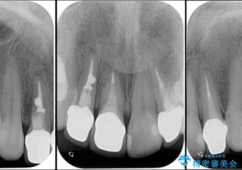 金属で変色した前歯を綺麗にしたい オールセラミッククラウンによる前歯の治療の治療後