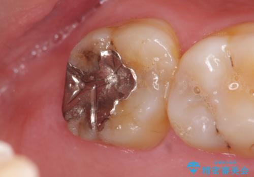 銀歯の劣化・セラミックインレー修復の治療前