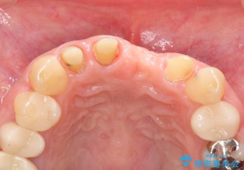 不良インプラントの除去・骨造成・歯肉移植・前歯審美セラミックブリッジ製作の治療後