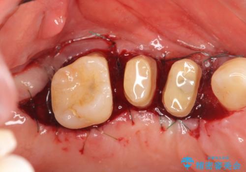 部分矯正を含む 歯周病治療 (再生治療・歯周ポケット除去・MTM・連結補綴)の治療中